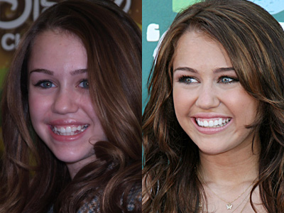 Celebrity Smile Makeover Under Review - Miley Cyrus - Perfect Smile